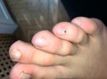 Пятно на ногте пальца ноги меланома или гематома? фото 4