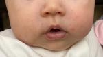 Высыпание на лице и теле у ребёнка 4 месяцев фото 3