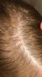 Прыщи на волосистости части головы фото 1