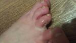 Воспаление пальца на ноге фото 1
