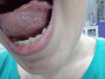 Воспаление под языком фото 3