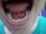 Воспаление под языком фото 4