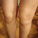 Проблемы с суставами коленей фото 3