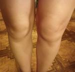 Проблемы с суставами коленей фото 2