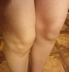 Проблемы с суставами коленей фото 1