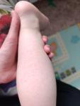 Беспокоит сыпь у ребенка на руках и ногах фото 3