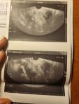 Киста правого яичника возможно онкология фото 2