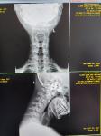 Рентген шейного отдела позвоночника фото 1
