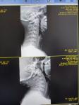 Рентген шейного отдела позвоночника фото 2