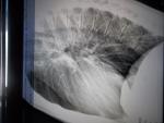 Рентген грудной клетки при пневмонии фото 2