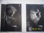 Киста яичника и гиперплазия эндометрия фото 1
