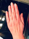 Боли суставов рук у практически здоровой женщины через 1,5 года менопаузы фото 5