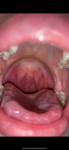 Болит горло, язык, воспалённые сосочки фото 1