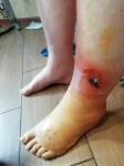 Рваная рана на ноге фото 2