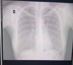 Рентген легких, подскажите пожалуйста была ли пневмония или нет фото 1