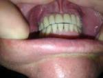 Эстетический вид зубов нарушен, должен врач переделать свою работу? фото 1