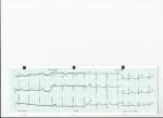 Верная ли расшифровка кардиограммы фото 2