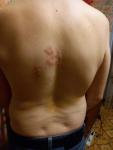 Как бороться с появившимися пятнами на спине и на груди? фото 2