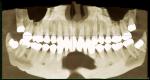 Хроническая боль в районе зубов, боль напряжения в висках фото 2