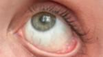 Пожелтение белков глаз и боли в правом подреберье фото 1