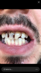 Ужасное состояние зубов, кариес на передних зубах, протезирование нужно фото 3