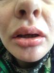 Фиброз после введения филлера в губы фото 1