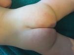 Аллергия или контактный дерматит у ребёнка фото 2