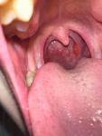 Болит горло (красные пятна) фото 1