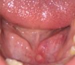 Воспаление-язва под языком или что это? фото 1