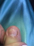 Деформация ногтей на ногах фото 2