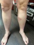 Непонятная шишка на ноге (голень) и покраснение фото 2
