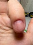 Темно-коричневая продольная полоска на ногте указательного пальца правой руки фото 2