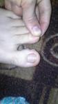 Что за бугры появились у меня на пальцах ноги? фото 2