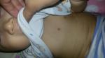 Пятна на теле у ребенка, стрептодермия, диатез фото 2