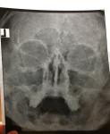 Дискофрот в носу и лобной части фото 1