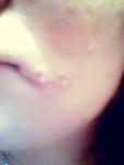 Болячки на губе и рядом с губой фото 1