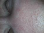 Проблема с кожей на лице после уколов мильгаммы фото 1