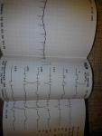Расшифровка электрокардиогораммы, сильное сердцебиение фото 3