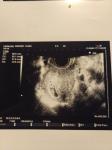 Гематома при беременности фото 1
