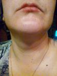 Сухость и шелушение кожи губ фото 1