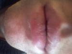 Болезнь губы фото 1