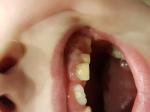 Петно на зубе у ребенка фото 1
