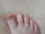 Грибок ногтей запущенная форма на ногах фото 1