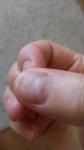 Бугристые ногти на больших пальцах рук фото 2