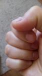 Бугристые ногти на больших пальцах рук фото 1