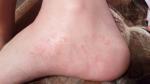 Сыпь на щиколодках ног сопровождается зудом, как лечить? фото 1