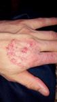 Аллергический дерматит на кисти рук фото 1