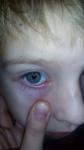 Глазное воспаление фото 1