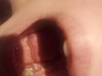 После удаление зуба, белый налет, болит фото 2