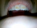 Желтизна на зубах фото 1